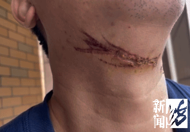 17岁男孩骑车路上遭“割喉”缝了21针！已有多人中招！近期千万小心！(图3)